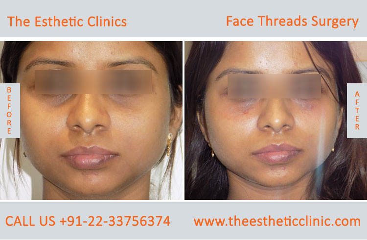 thread facelift, face lifting with threads treatment before after photos in mumbai india (7)